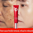 Creme forte original para remover manchas escuras/clareamento pigmentado/cuidados com a pele